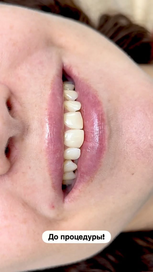 Композитные виниры — результат работы