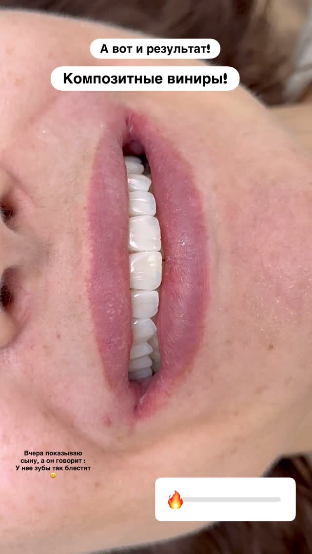 Композитные виниры — до и после