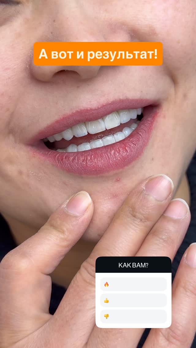 Композитные виниры — кейс