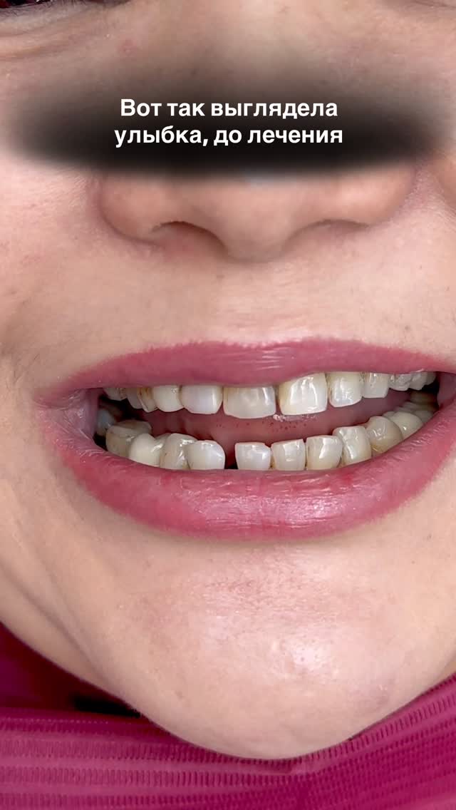 Композитные виниры — результат