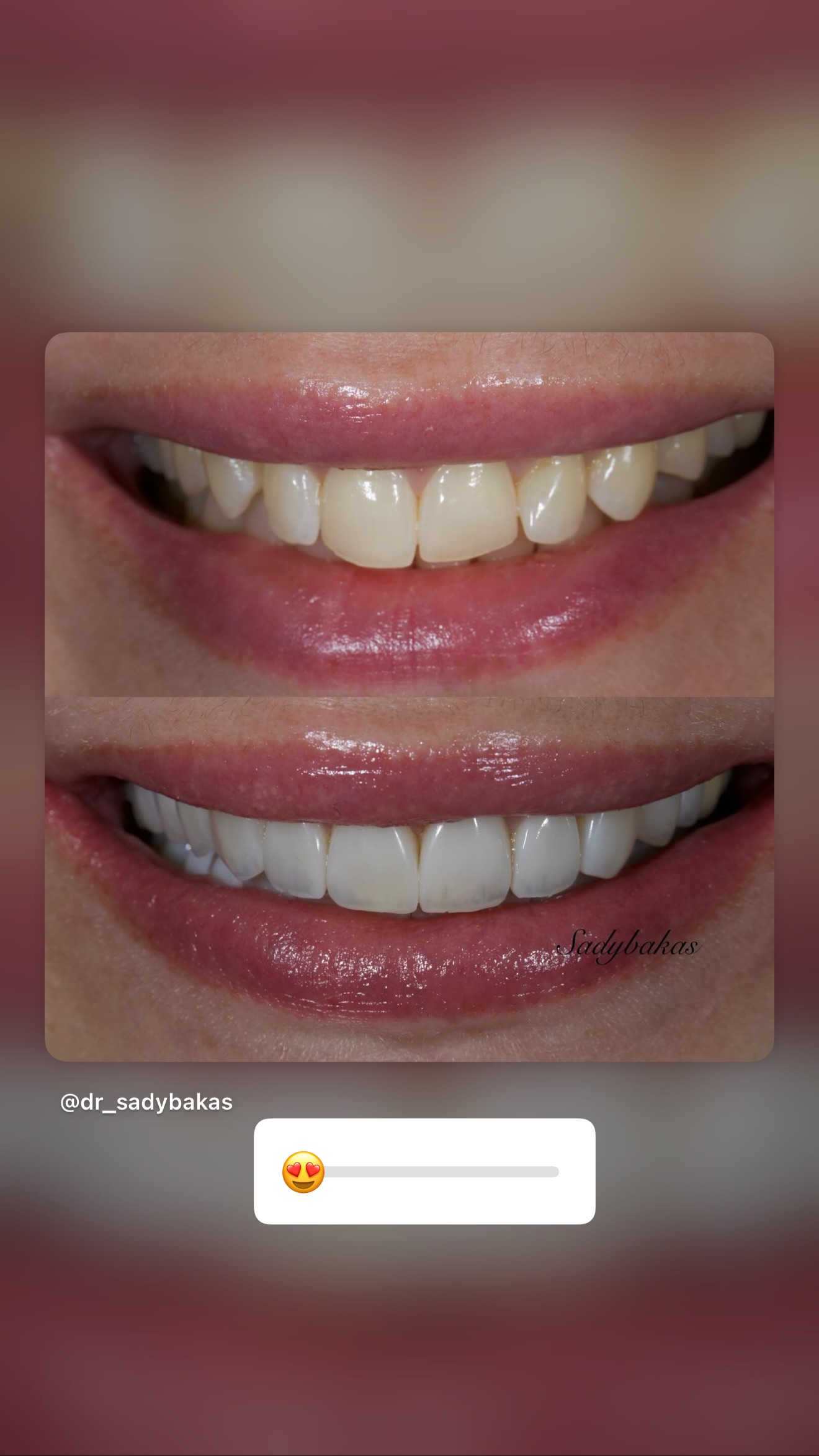 Композитные виниры — улыбка