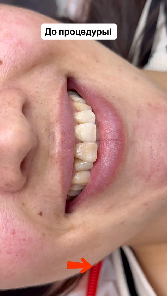 Композитные виниры — работа