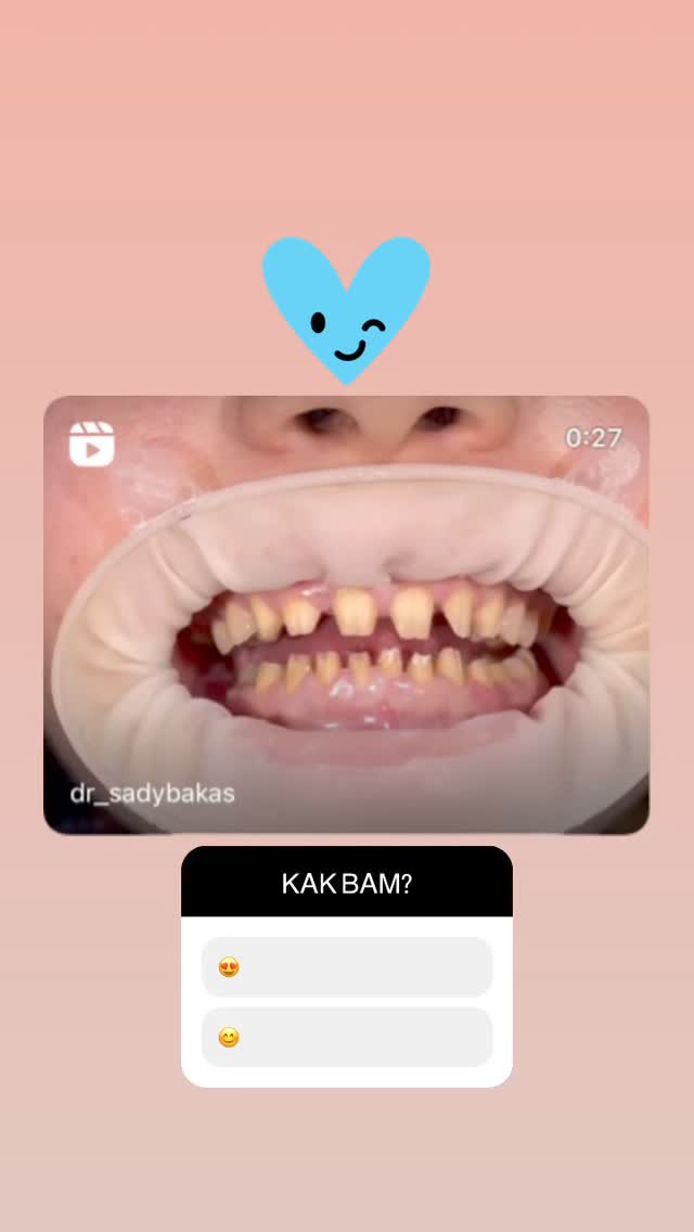 керамические виниры