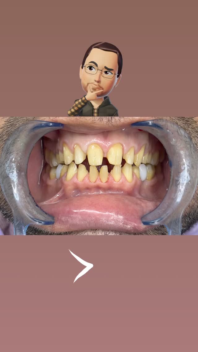 Керамические виниры — результат