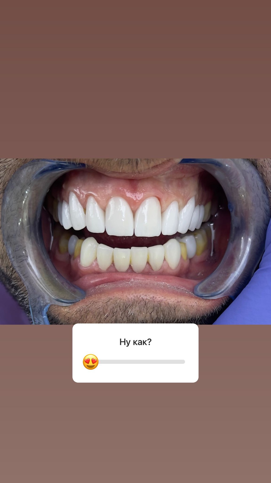 Керамические виниры — кейс