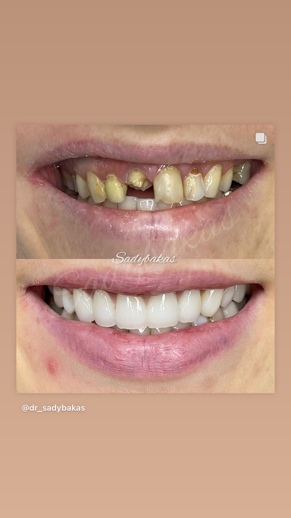 Керамические виниры — работа