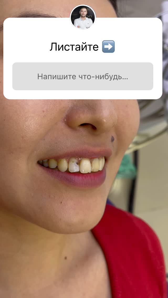 Керамические виниры — процесс