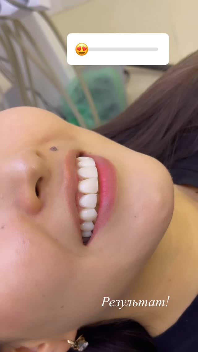 Керамические виниры — улыбка