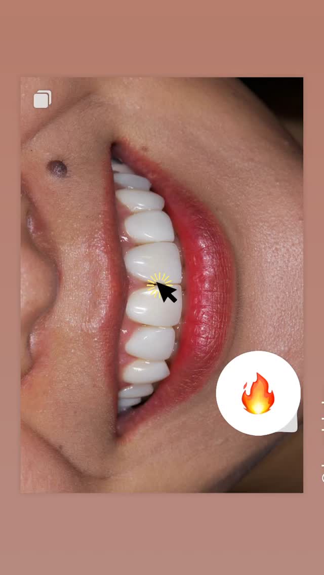 Керамические виниры — пример