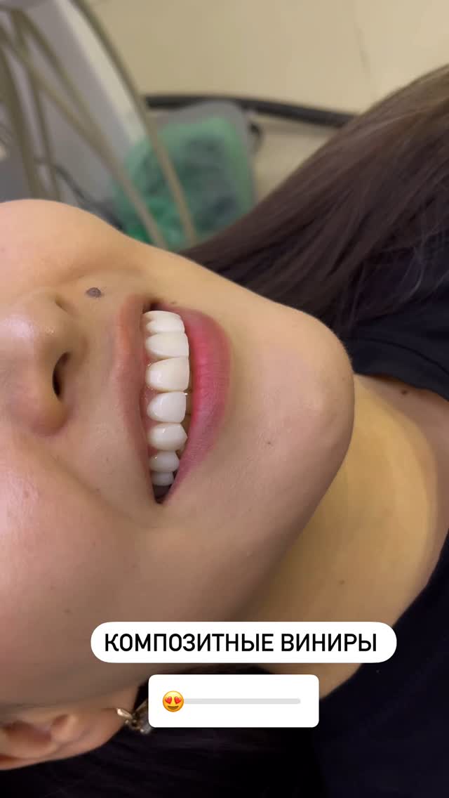 Композитные виниры — пример