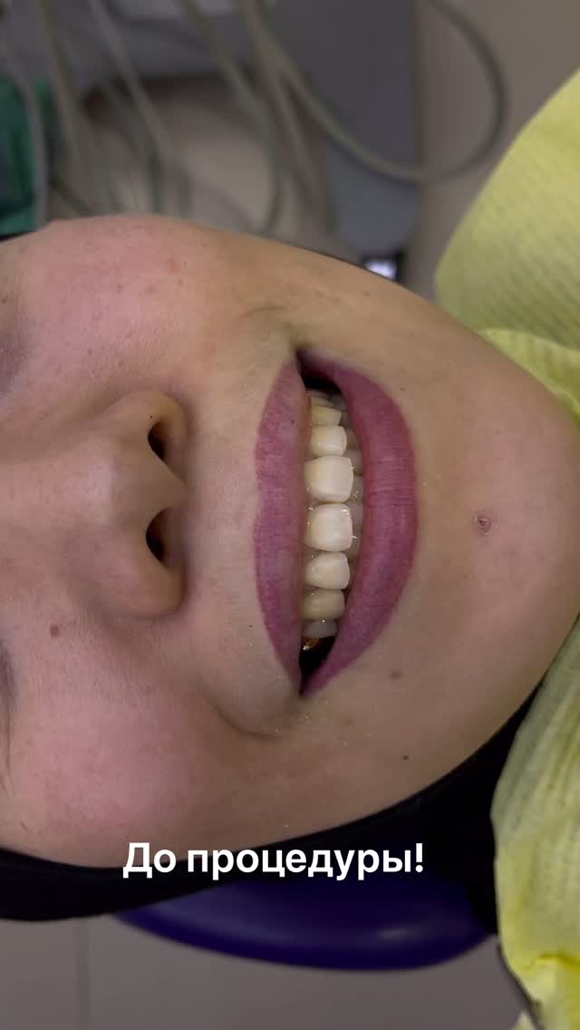 Композитные виниры — процесс