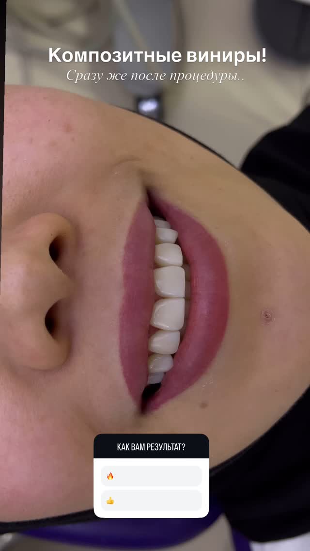 Композитные виниры — результат работы