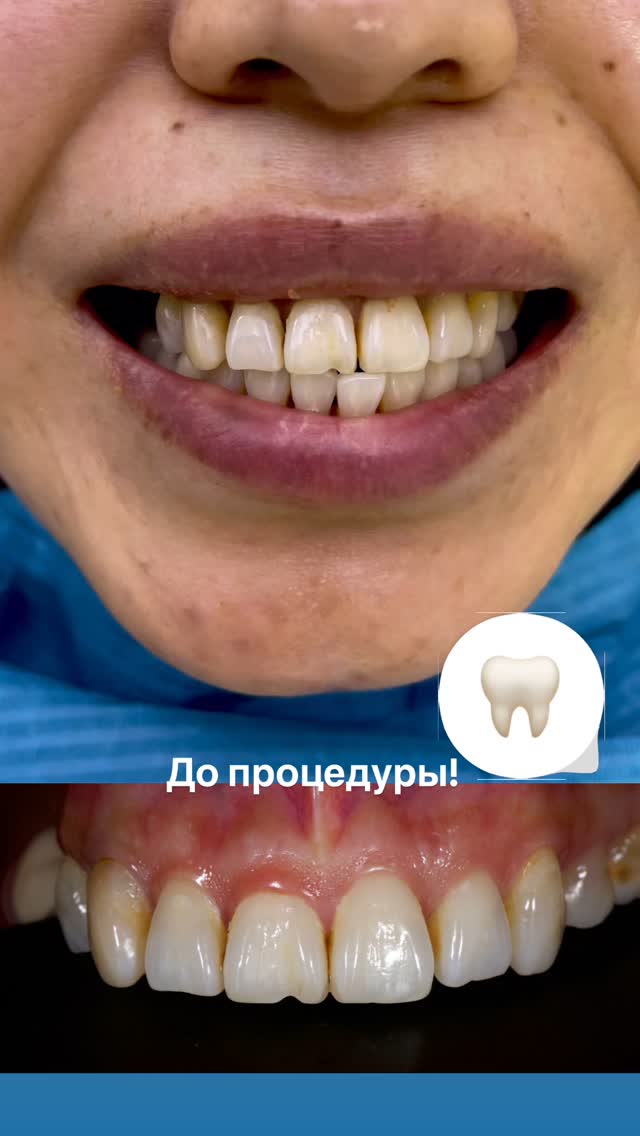 Виниры до и после 4