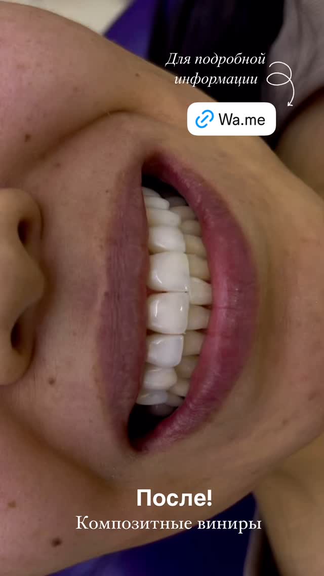 композитные виниры