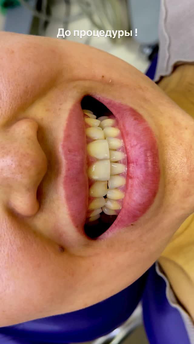 Виниры до и после 6