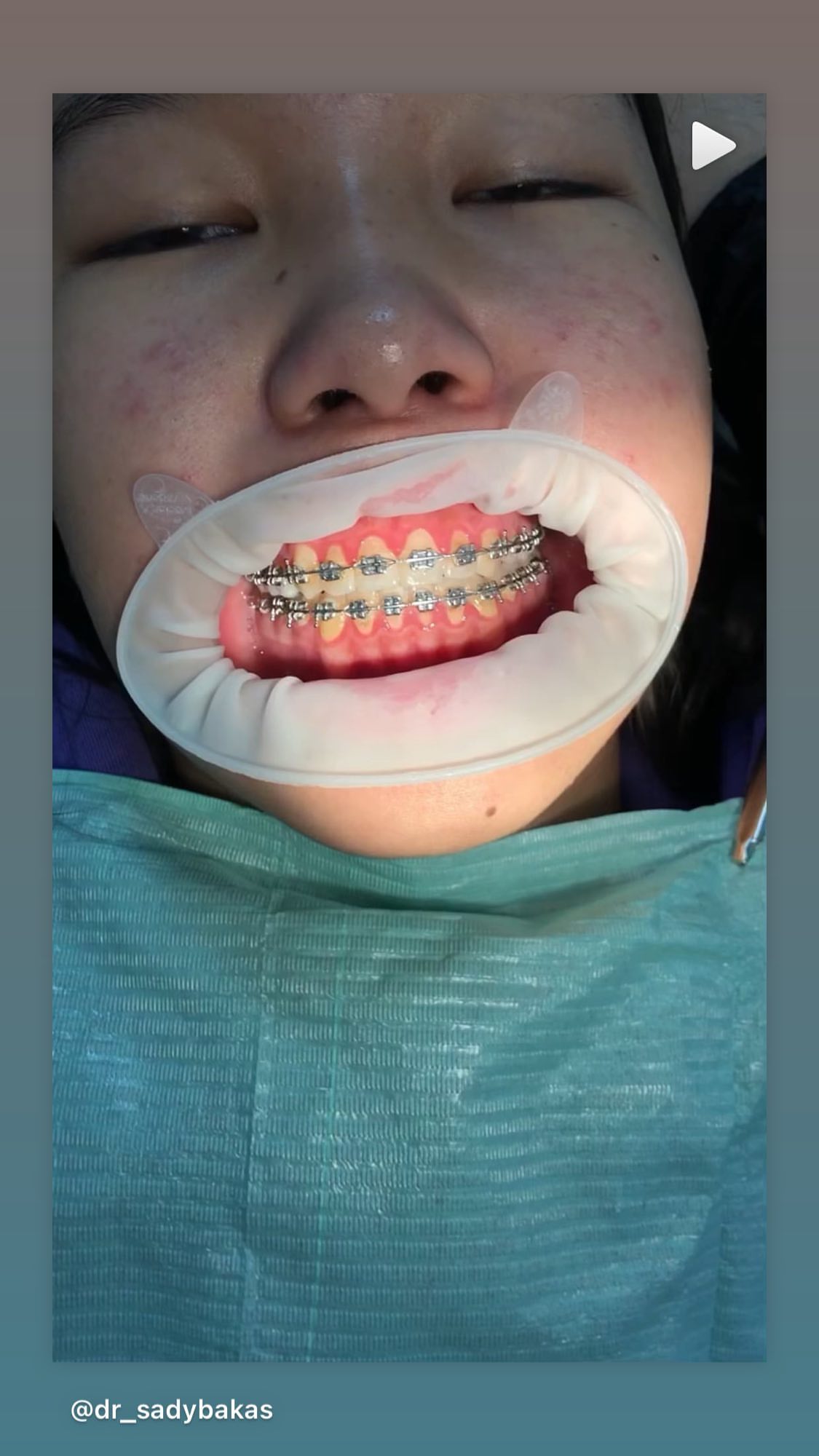 Брекеты результат 2