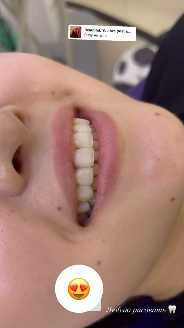 Циркониевые коронки