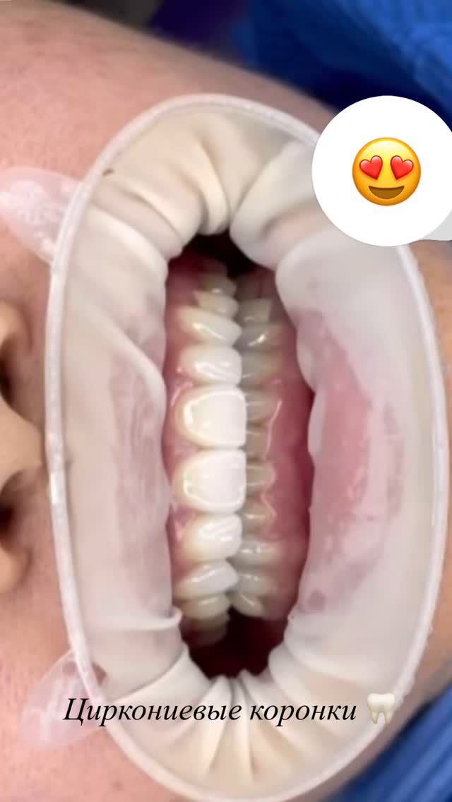 Циркониевые виниры