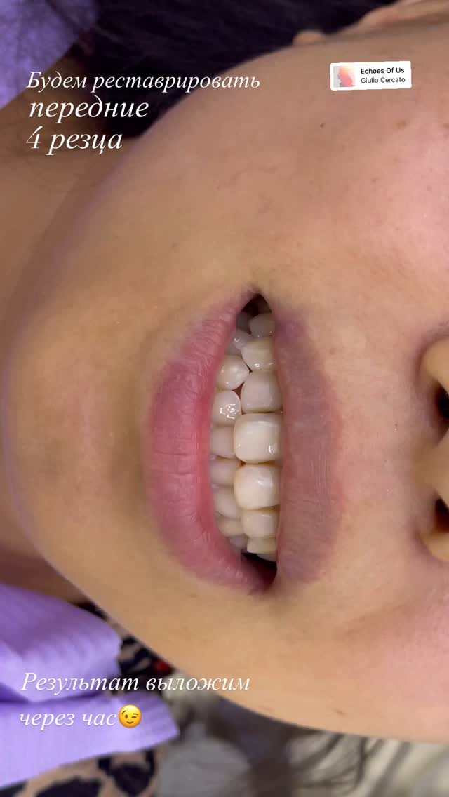 Циркониевые коронки 2