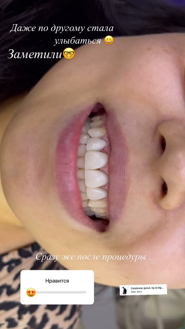 Циркониевые коронки 3