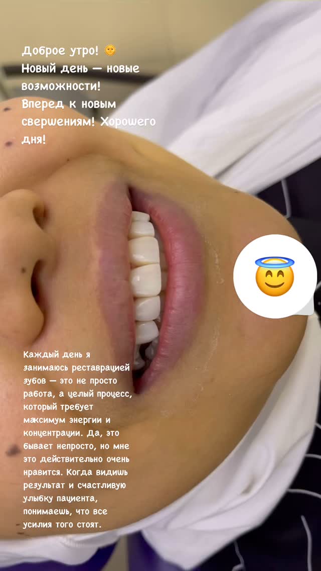 Виниры результат