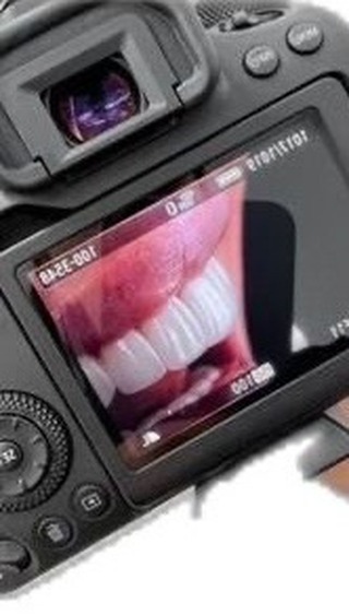 Композитные виниры