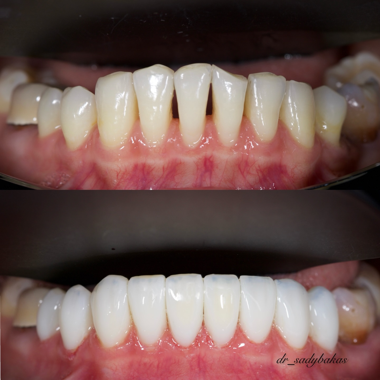 Керамические виниры